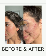 Sacred Skin | Acne Serum + Moisturizer
